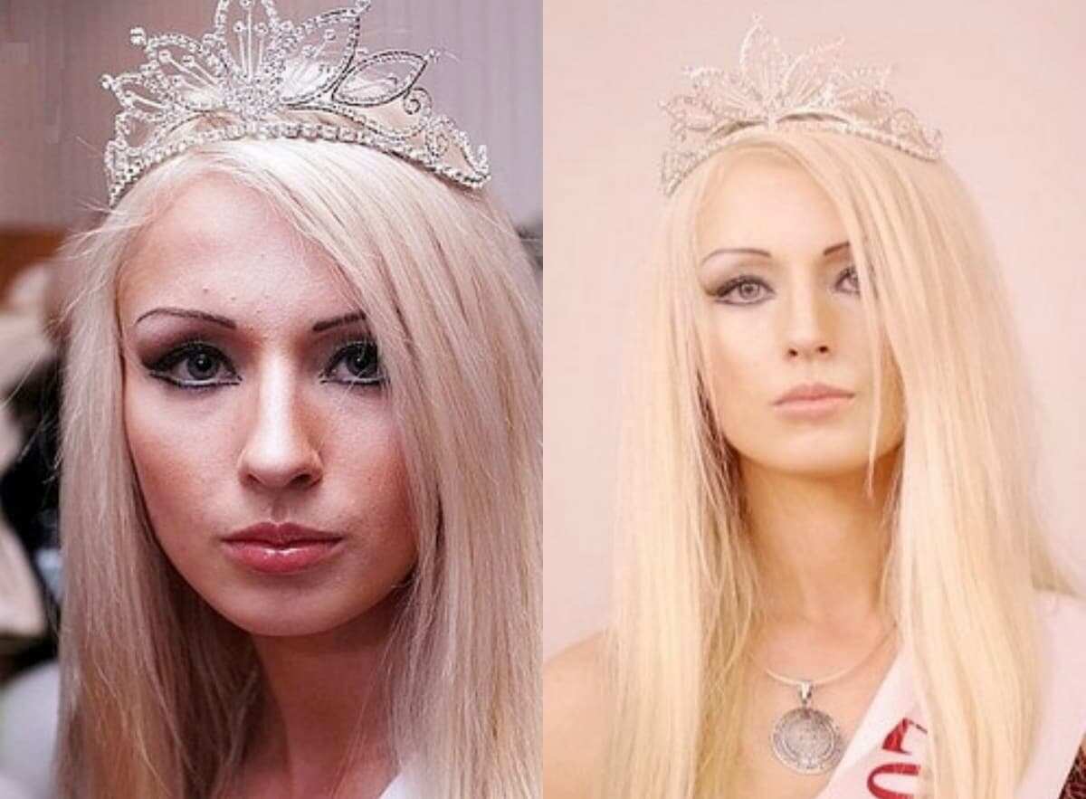 valeria lukyanova before and after surgery