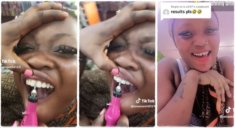 A lady gets artificial diastema popularly called open teeth.