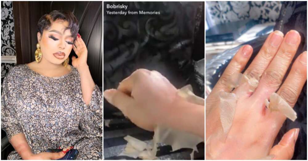 Bobrisky shares photos of his skin peeling as he bleaches skin.Photos: @bob...