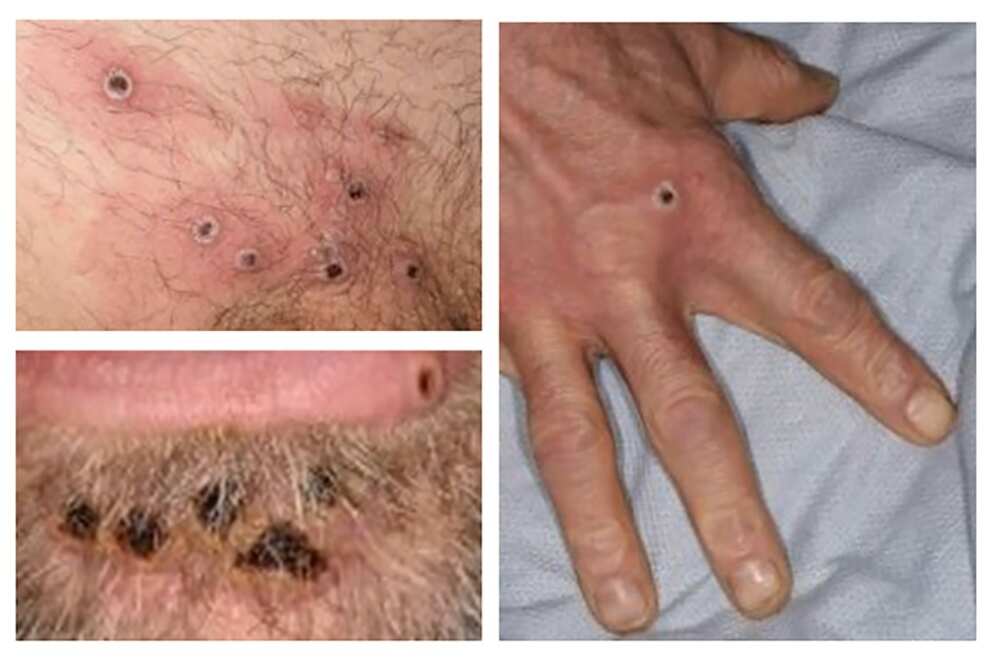 Most of the new monkeypox cases have been recorded in Europe Most of the new monkeypox cases have been recorded in Europe