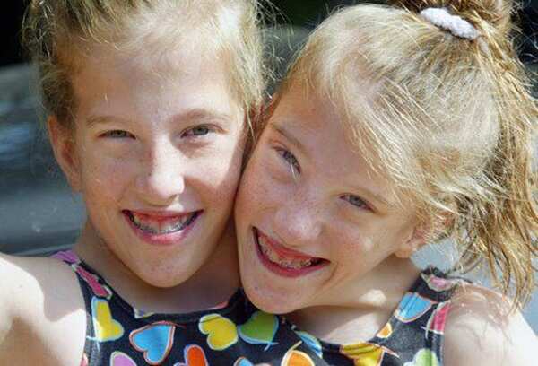 Abby and Brittany Hensel young age