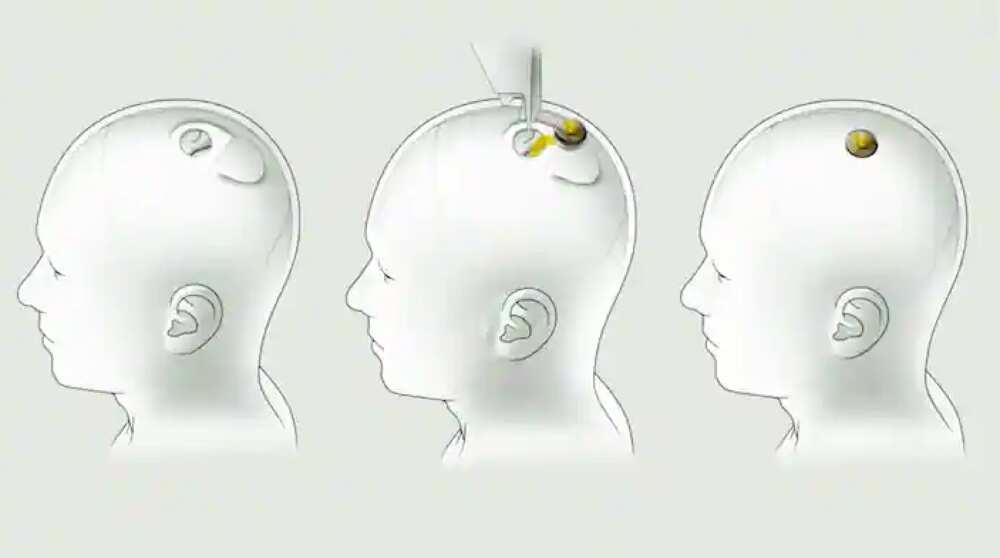Elon Musk/ Neuralink/ brain implant Elon Musk/ Neuralink/ brain implant