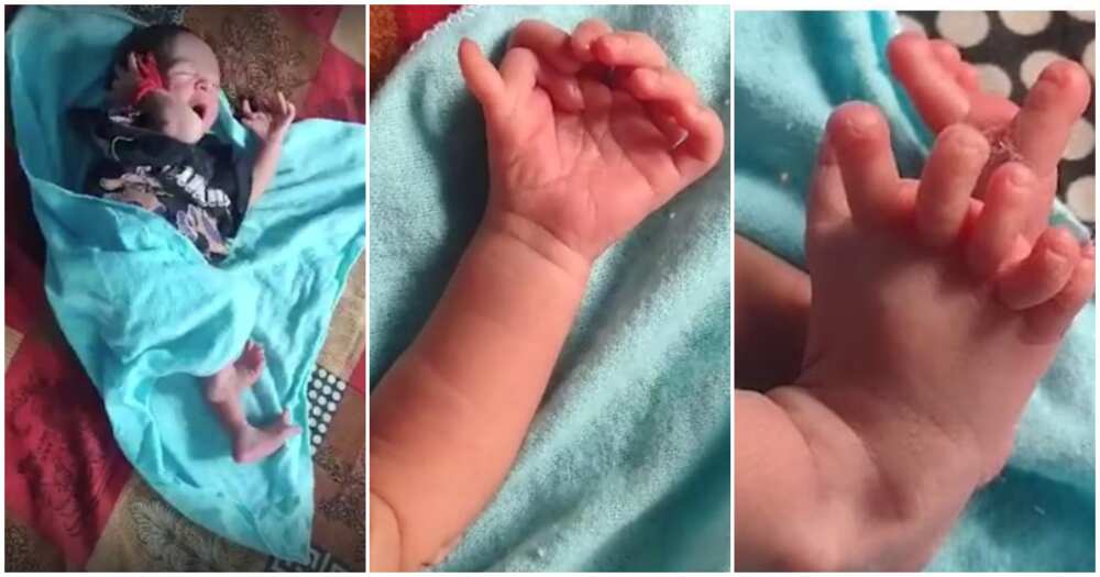 Baby born with 26 fingers and toes, India, Bharatpur