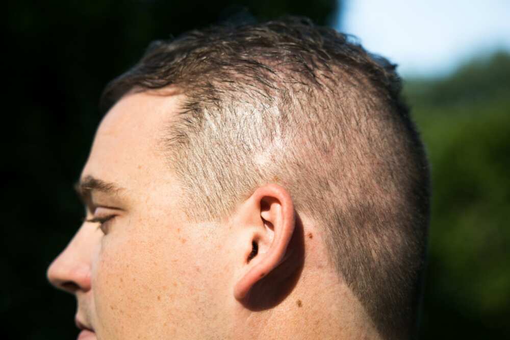 The scar above Burkhart's ear, where the map became once previously screwed in. 'Your scalp is making an strive to discontinuance the overall time,' he stated The scar above Burkhart's ear, where the map became once previously screwed in. 'Your scalp is making an strive to discontinuance the overall time,' he stated