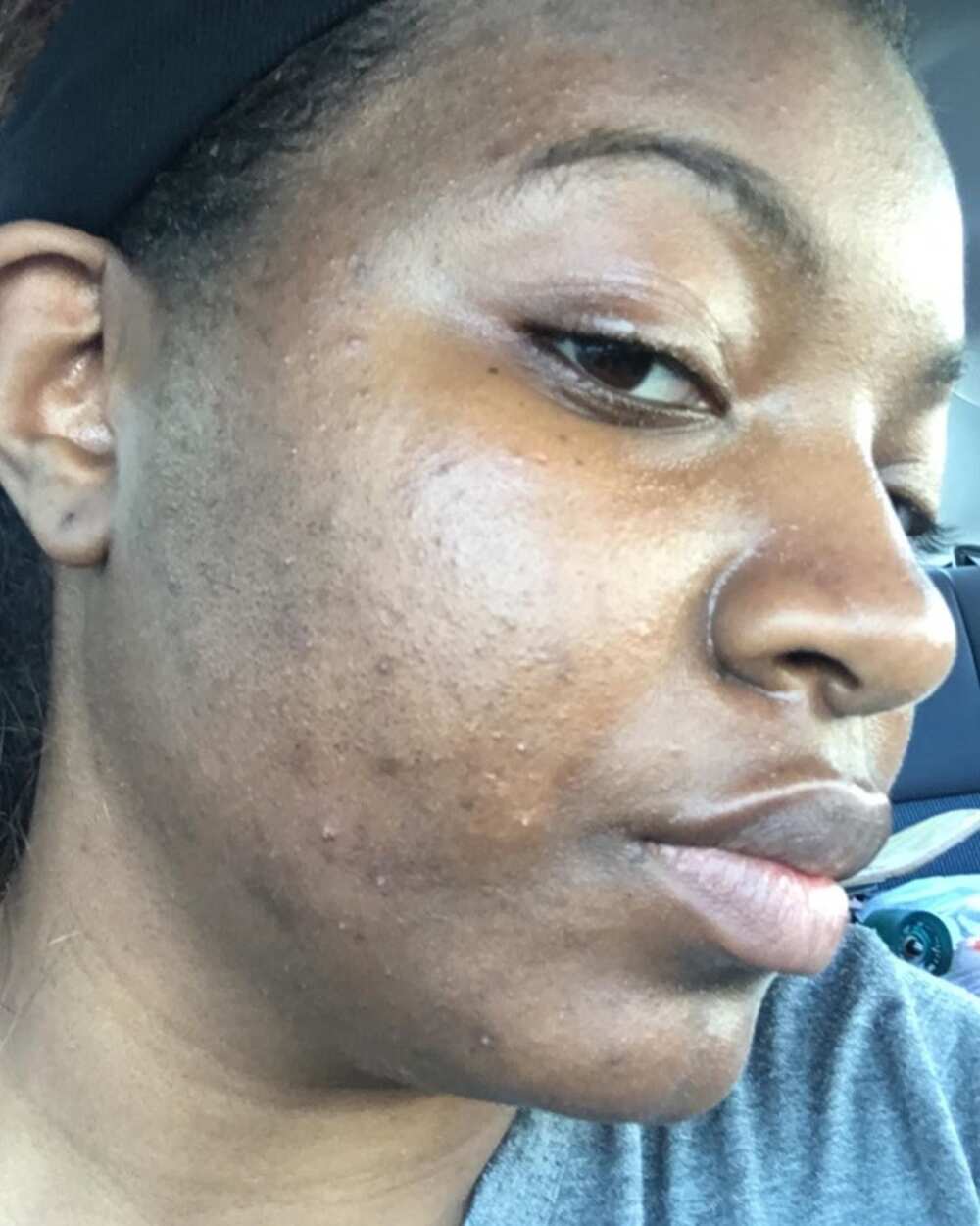 Spots on face