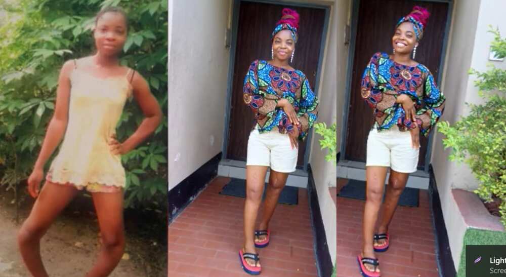 Photos of a lady with bowlegs after corrective surgery.