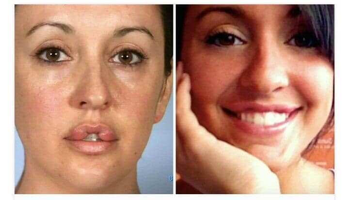 Catherine Reitman before surgery