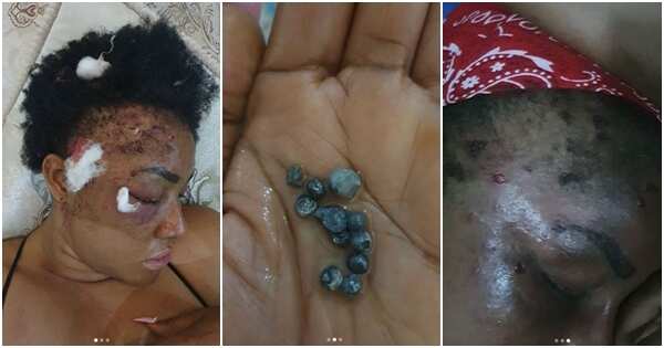 Angela Okorie shares photo of pellets removed from her head after alleged assassination attempt
