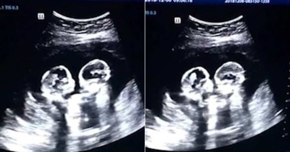 Ultrasound scan spots identical twin sisters ‘fighting’ in their mother’s womb (video)