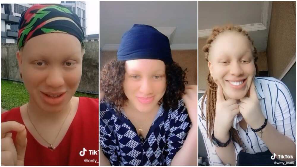 Living with albinism in Nigeria/albino without dark spots. Living with albinism in Nigeria/albino without dark spots.