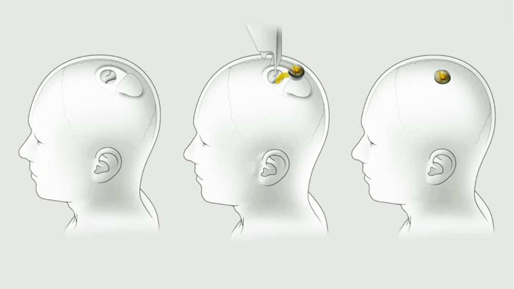 Elon Musk reveals microchips for Human Brains ready from 2022 control your phone without touching it Elon Musk reveals microchips for Human Brains ready from 2022 control your phone without touching it