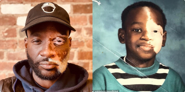 "It's Been My Greatest Blessing": Man with a Skin Disease Overcomes Child Bully To Become a Great Influencer