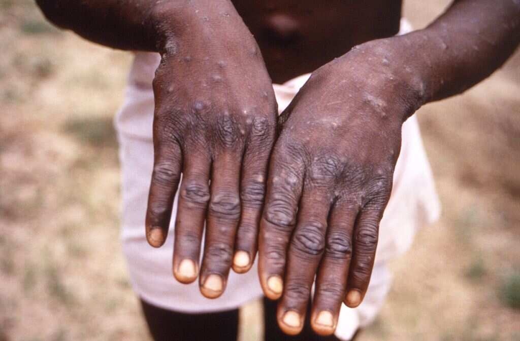 Gay community have higher spread of monkeypox, US officials warn