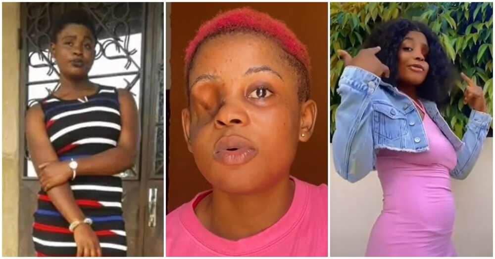 Cameroonian lady, Naronate Akum Ngwa who lost her eye after a gunshot.