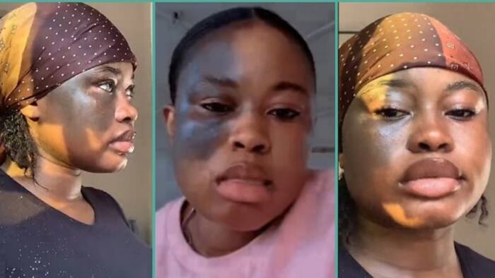 "Everyone stares at me when I expose it": Video of Nigerian lady with unusual birthmark goes viral