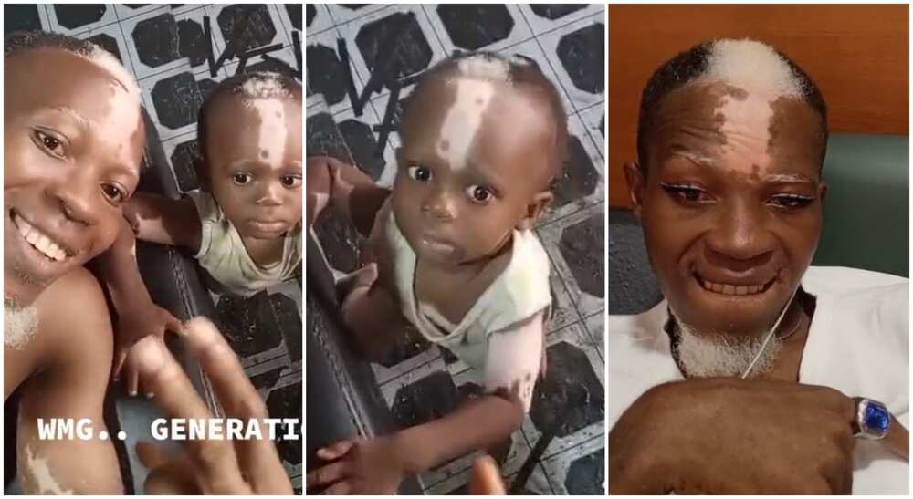 Photos of a handsome man and his cute son thought to have vitiligo.