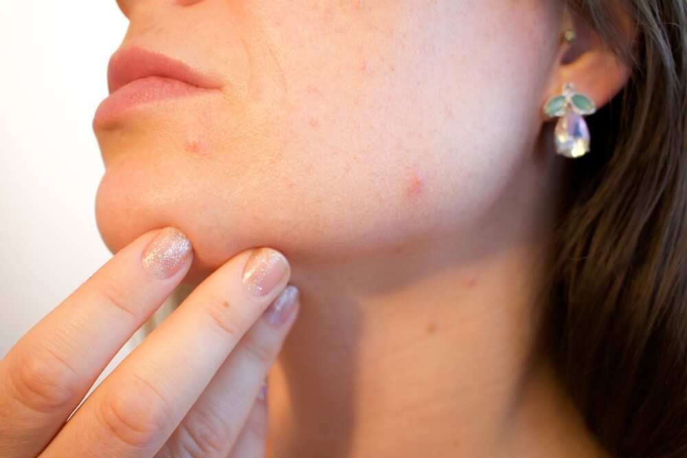 One of the most common skin diseases - acne