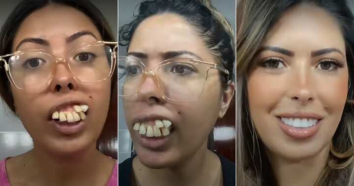 Lady With Crooked Teeth Shows Off Transformation After Undergoing Dental Surgery Video Trends 6266