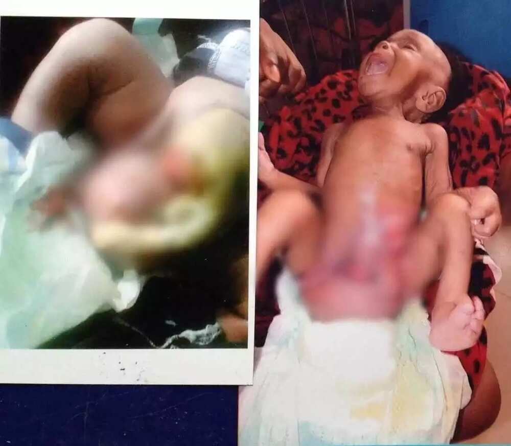 An haifi jariri ba tare da dubura ko mazakuta ba An haifi jariri ba tare da dubura ko mazakuta ba