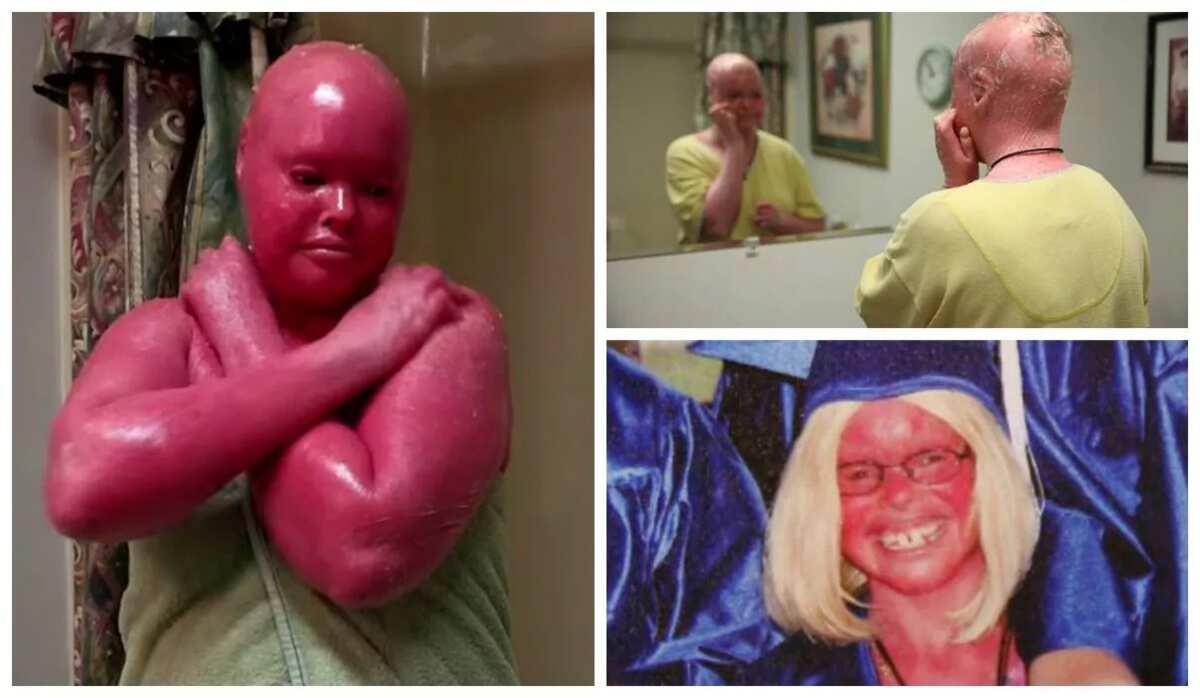 Woman With Harlequin Ichthyosis Becomes Mother Of Two Legit.ng