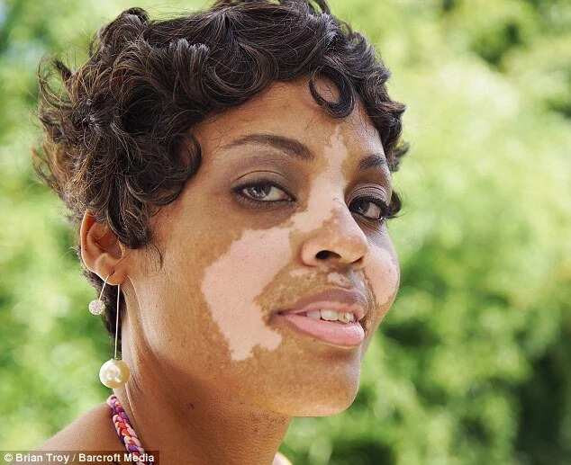Black Woman With Vitiligo Tells Her Touching Story