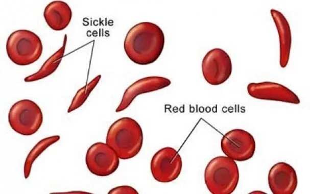 Anaemia