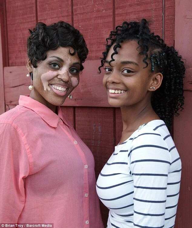 Black Woman With Vitiligo Tells Her Touching Story