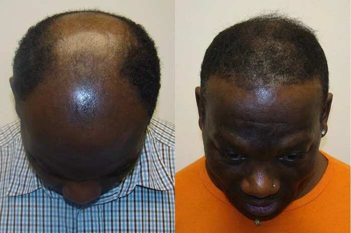 Abuja man reveals how he regrew his hair, cured baldness and severe hair loss within 14 days using a natural herbal remedy