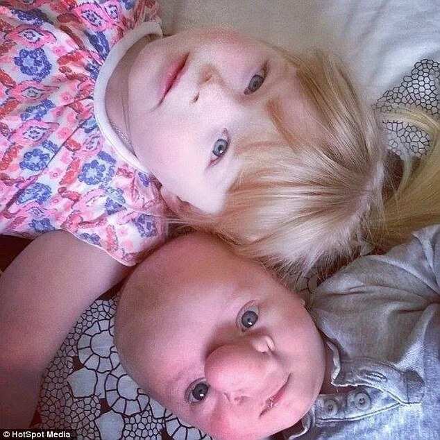 Baby Dubbed Pinocchio After Being Born With Brain In His Nose