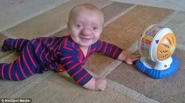 Baby Dubbed Pinocchio After Being Born With Brain In His Nose
