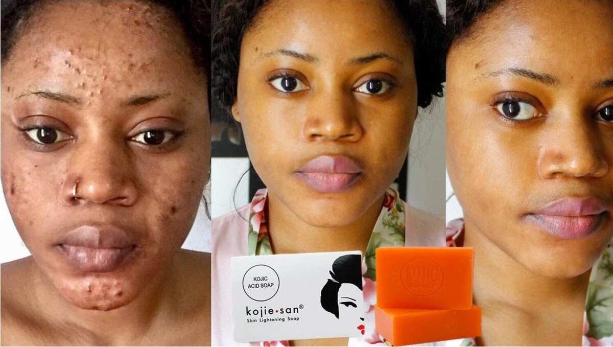 Kojic acid deals for skin