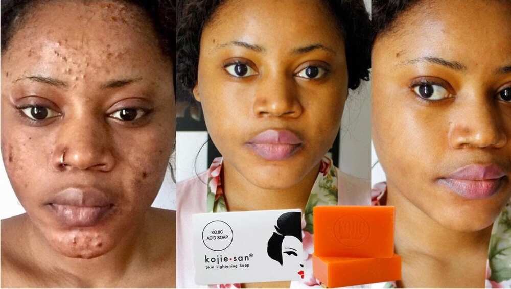 kojic acid before and after