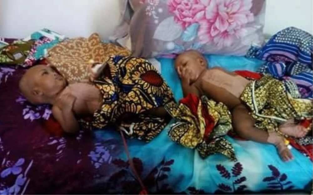 Team of surgeons successfully separate conjoined twins in Yola