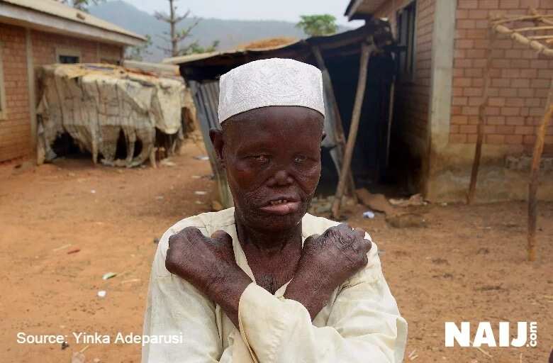 Special Report: The lonely existence of lepers