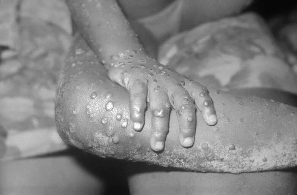 10 major facts about the monkeypox virus